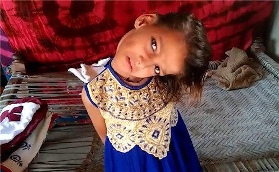 女孩头部无法竖立,被视为罪恶遭排挤