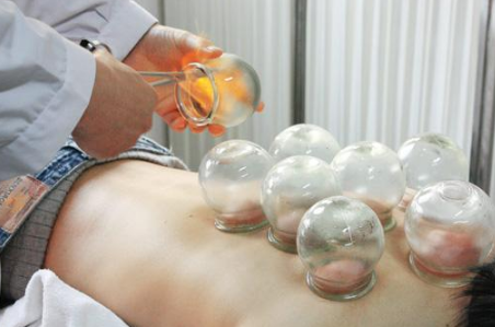 『拔罐』除寒气通气血 定期拔罐好处多