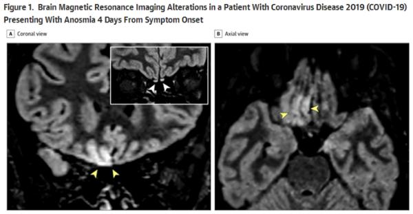 最新研究：新冠患者大脑核磁成像出现改变 嗅觉丧失为新冠主要症状