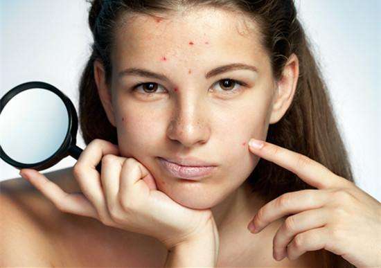 教你9个小妙招快速祛除痘印