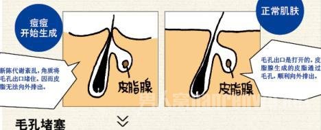 痘痘形成的原因是什么？脸上长痘痘的原因是什么？