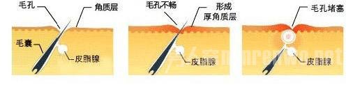 痘痘形成的原因是什么？脸上长痘痘的原因是什么？