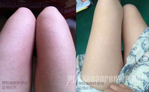 怎么去鸡皮肤简单方法，去鸡皮肤最有效的方法一定不能错过！