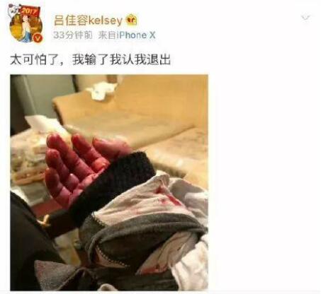 吕佳容受伤深夜送医院 自称是下一个乔任梁？