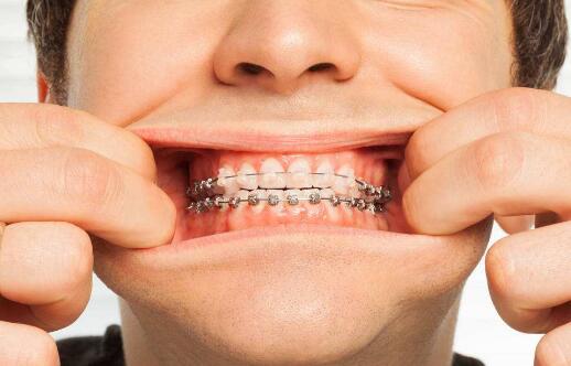 戴牙套会导致打呼噜吗？戴牙套有什么用