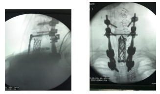 3D打印技术助专家精准切除脊柱肿瘤