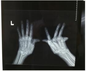 36年类风湿令手脚关节严重畸形 矫形后第一件事是竖拇指给医生点赞