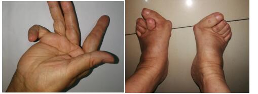 36年类风湿令手脚关节严重畸形 矫形后第一件事是竖拇指给医生点赞