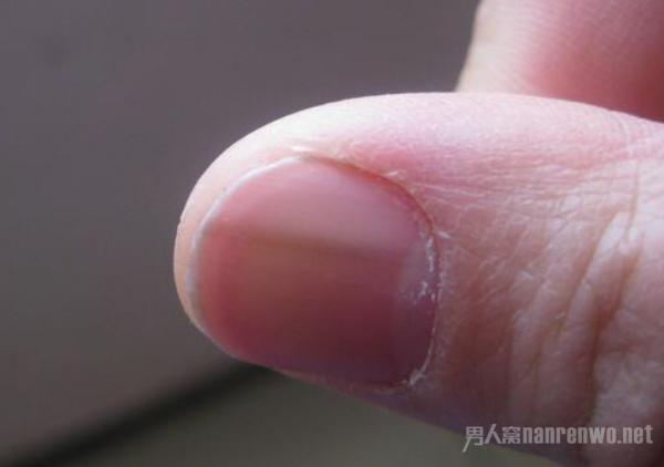指甲上有竖纹是怎么回事 看看专家是怎么说的