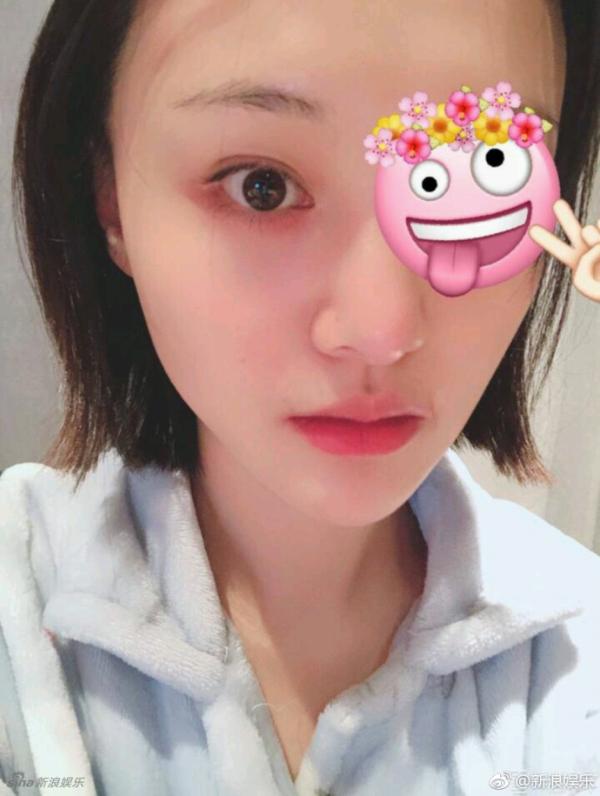 郑爽眼睛受伤带纱布出席活动获赞 网友:希望快