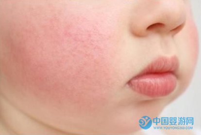 「周岁宝宝」周岁宝宝常见疾病，专家来支招