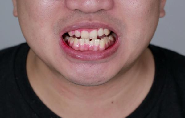 祛除顽固牙菌斑 XWAVES小蛮腰冲牙器效果实测