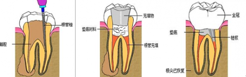 西班牙Lacer牙膏|成人龋齿常见的问题有哪些？