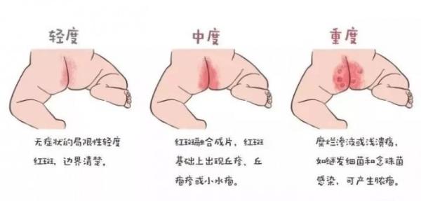 婴幼儿夏季“防痱“指南