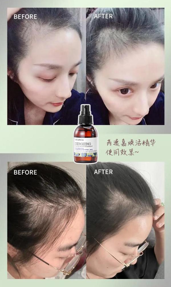 爆款网红生发精华大测评： 拯救“秃”如其来发际线！