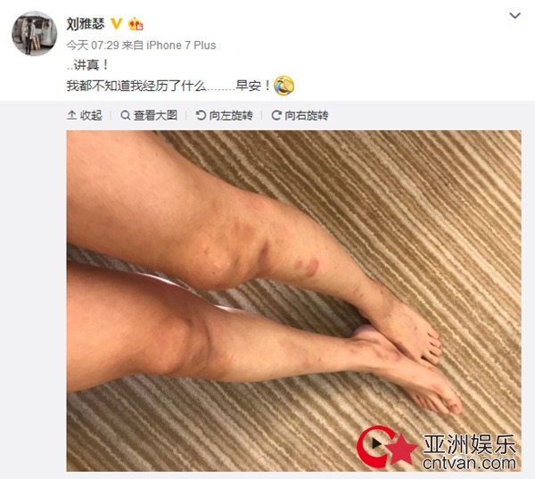 刘雅瑟微博晒照似拍摄新戏智齿受伤