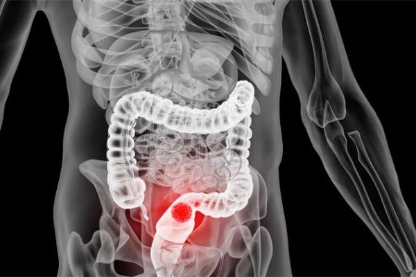 新研究表明：肠道内含有某些细菌，患结肠癌的风险更大 