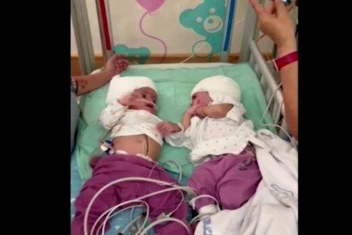 罕见！以色列1岁连体女婴分离手术成功 生下来首次见面有了眼神交流 