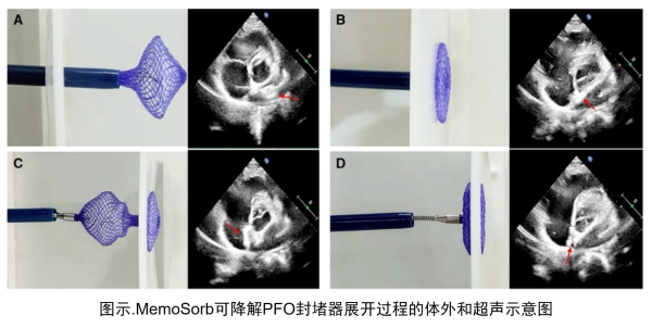 老年患者PFO介入治疗，为何更需关注“可降解”？ 