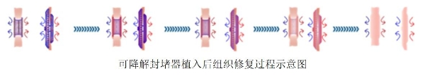 “补心”不留痕，健康守基层——可降解封堵技术加速落地县域医院 