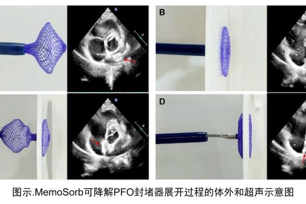 老年患者PFO介入治疗，为何更需关注“可降解”？ 