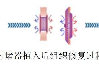 “补心”不留痕，健康守基层——可降解封堵技术加速落地县域医院 