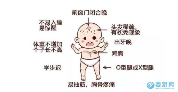 宝宝佝偻病的症状图片