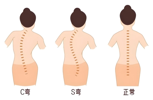 公益｜龙脊康脊柱侧弯万人筛进校园，守护孩子脊柱健康！