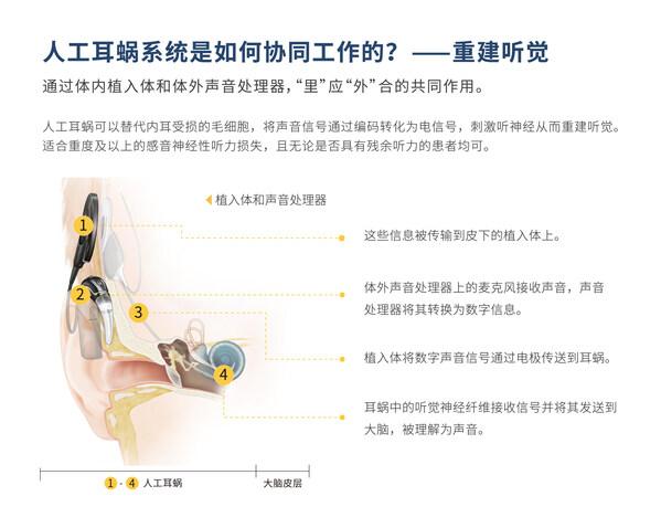 早启双耳聆听 为孩子把握好听损干预“黄金期”