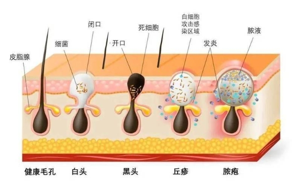 hfp果酸精粹水怎么样？真像网上说的那样好用么？ 