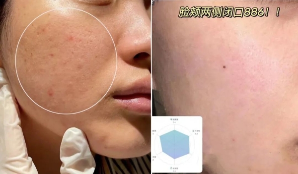 hfp果酸精粹水怎么样？真像网上说的那样好用么？ 