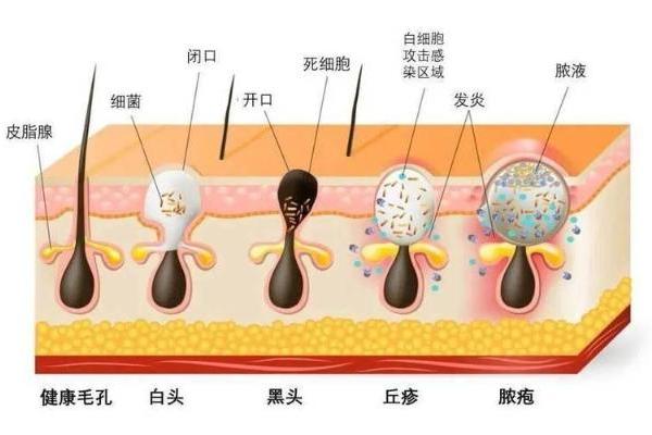 hfp果酸精粹水怎么样？真像网上说的那样好用么？ 