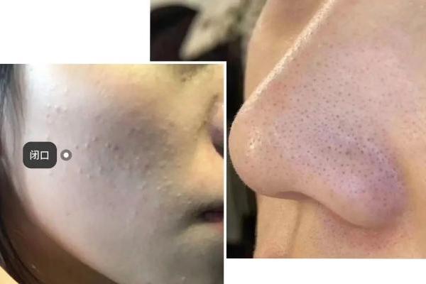 hfp果酸精粹水怎么样？真像网上说的那样好用么？ 