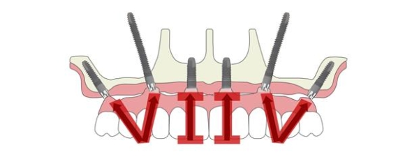 三城联动，盛大启幕 | 鼎植口腔第四届VIIV专利种牙节温暖相约沪、甬、深 