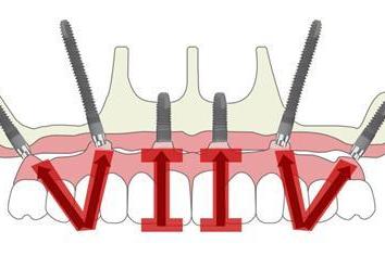 三城联动，盛大启幕 | 鼎植口腔第四届VIIV专利种牙节温暖相约沪、甬、深 
