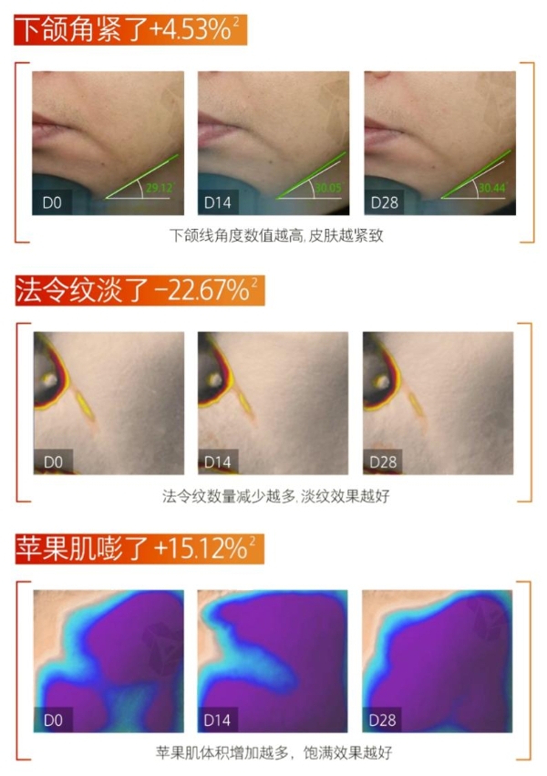 为什么我会推荐你试试hfp淡纹紧致嘭弹面霜 