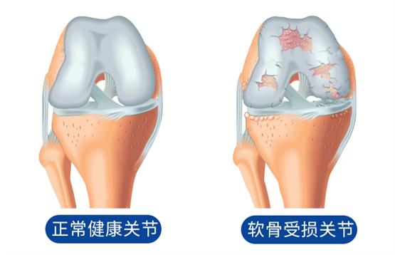 结晶型硫酸氨糖获国际指南推荐，伊索佳成关节养护优选 