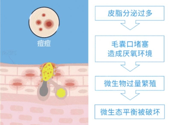 hfp果酸角质管理精华液：专研油皮抛光方案，打破油氧痘内耗 