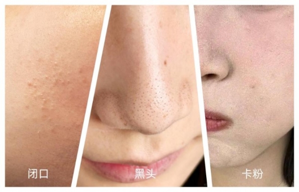 hfp果酸角质管理精华液：专研油皮抛光方案，打破油氧痘内耗 