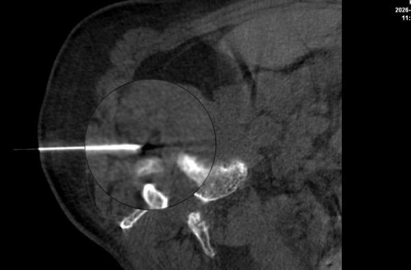 腰腿剧痛彻夜难眠！超声引导下神经根阻滞术为89岁老人精准解除病痛 