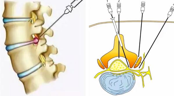 腰腿剧痛彻夜难眠！超声引导下神经根阻滞术为89岁老人精准解除病痛 