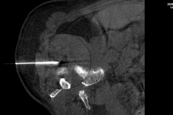 腰腿剧痛彻夜难眠！超声引导下神经根阻滞术为89岁老人精准解除病痛 