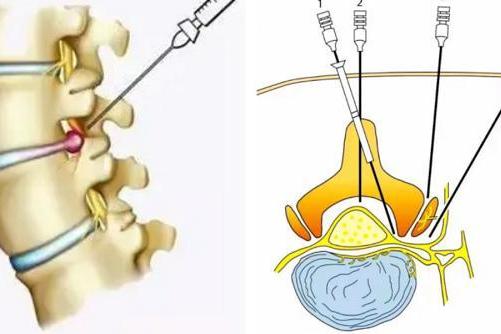 腰腿剧痛彻夜难眠！超声引导下神经根阻滞术为89岁老人精准解除病痛 