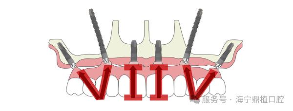 海宁种植牙哪里靠谱？海宁鼎植口腔盛大开业，VIIV疑难种植基地上海专家工作室正式成立 