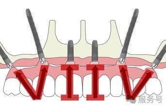 海宁种植牙哪里靠谱？海宁鼎植口腔盛大开业，VIIV疑难种植基地上海专家工作室正式成立 