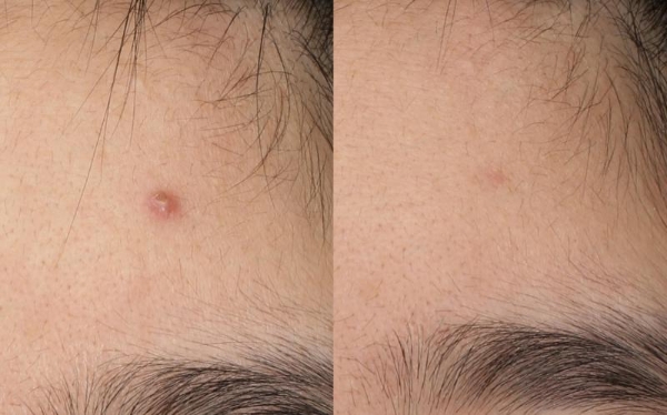 春夏换季易敏，hfp酸酶痘后面膜陪你科学“战痘” 