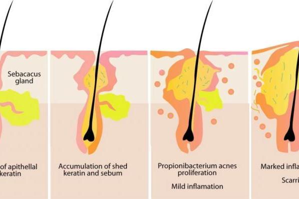 春夏换季易敏，hfp酸酶痘后面膜陪你科学“战痘” 