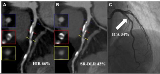 全球首篇！国际顶刊Radiology发布中国研究：冠脉CT精准评估迎来新方案 
