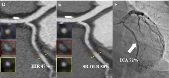 全球首篇！国际顶刊Radiology发布中国研究：冠脉CT精准评估迎来新方案 