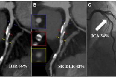 全球首篇！国际顶刊Radiology发布中国研究：冠脉CT精准评估迎来新方案 